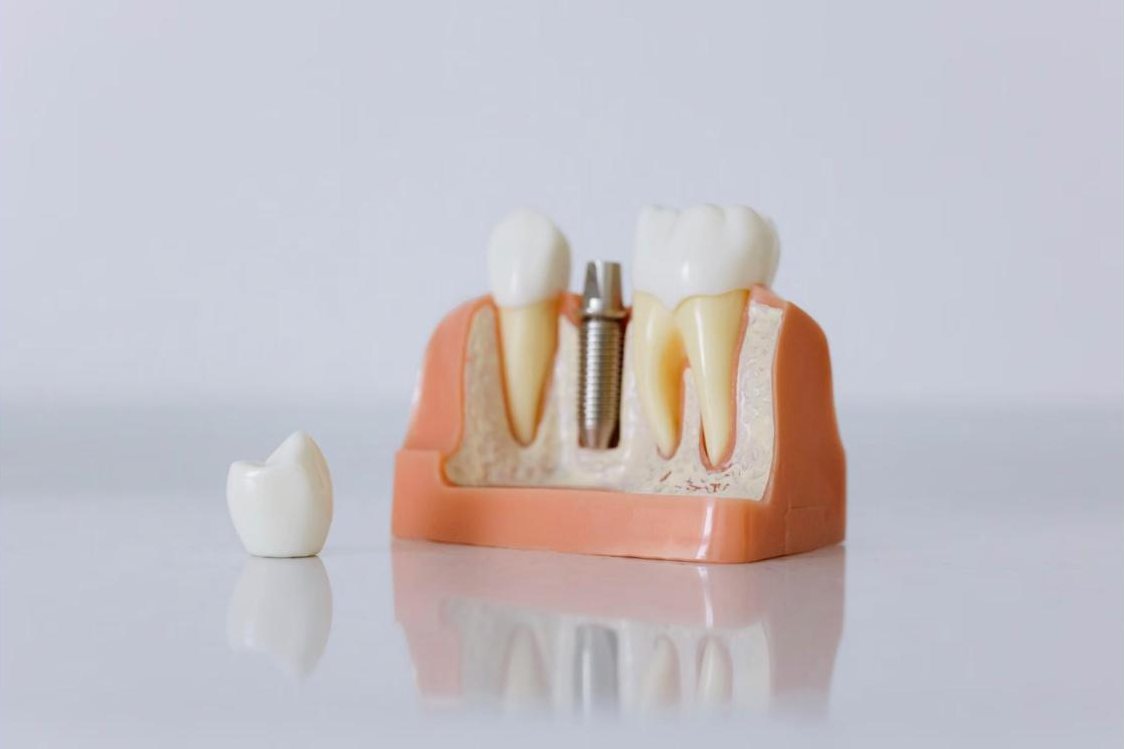 Modèle pédagogique d'implant dentaire présenté en cabinet